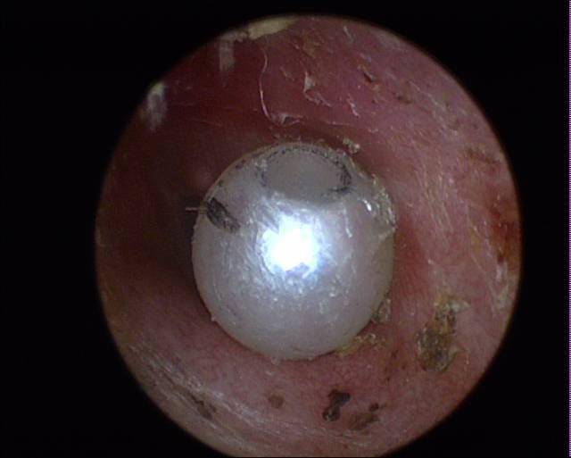 惊悚这些人耳朵疼竟然取出蟑螂蜘蛛