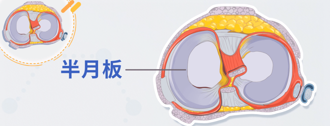 半月板損傷不可逆半月板損傷的自我判斷與常見治療方法