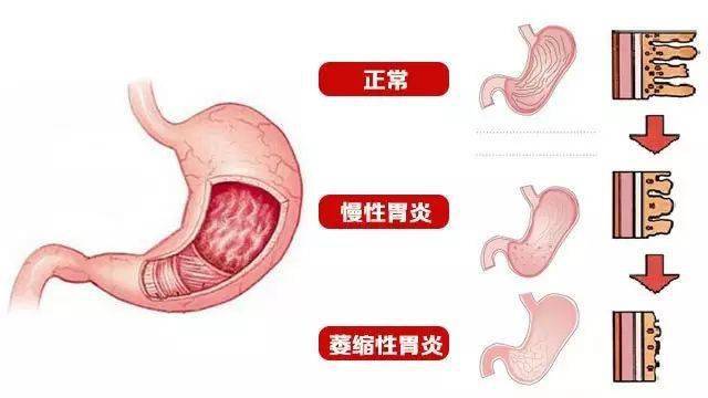 萎缩性胃炎隐痛胀气没食欲3款药膳用了都说好