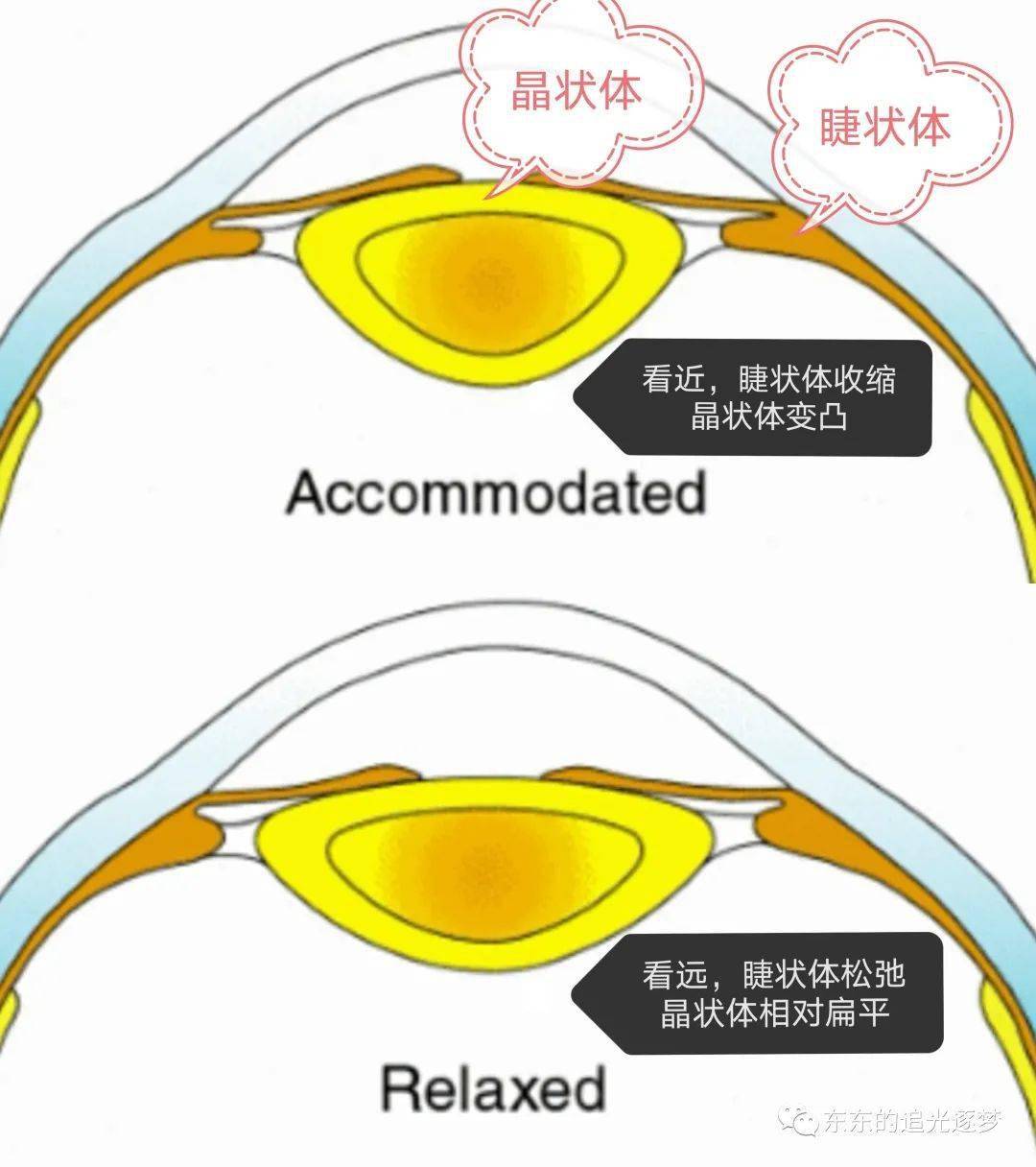 皮质混浊,囊膜弹性不足,睫状肌功能减退,因此人眼调节力下降,从而出现
