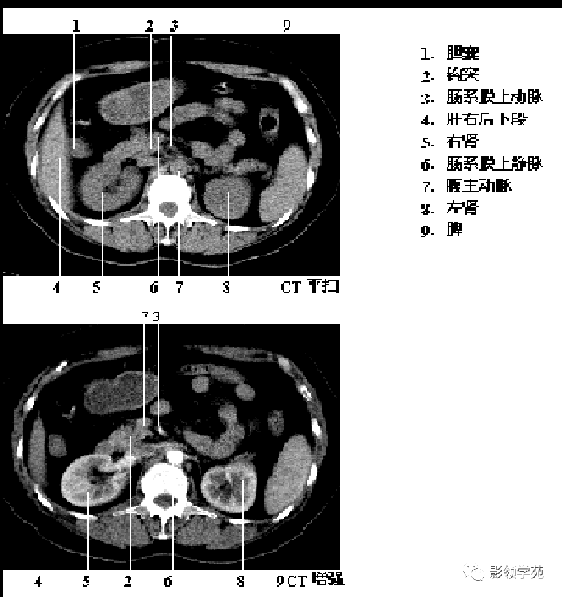 9種胰腺常見疾病的ct診斷_十二指腸