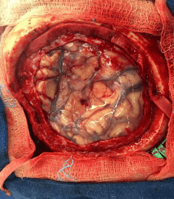 蛛网膜开颅手术图片图片