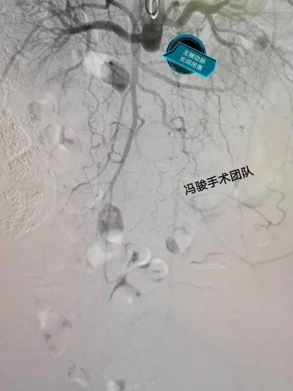 冯骏手术团队leriche综合征近肾主髂动脉长段闭塞腔内介入治疗