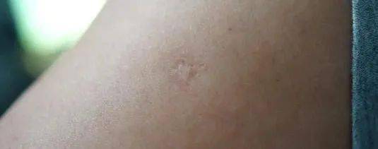 牛痘疫苗疤痕手臂图片