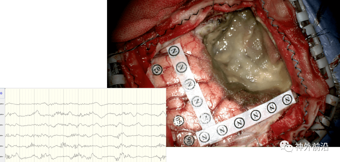 3 鏡下全切病變及切瘤後ecog首先在切除腫瘤之前,我們進行了皮層腦電