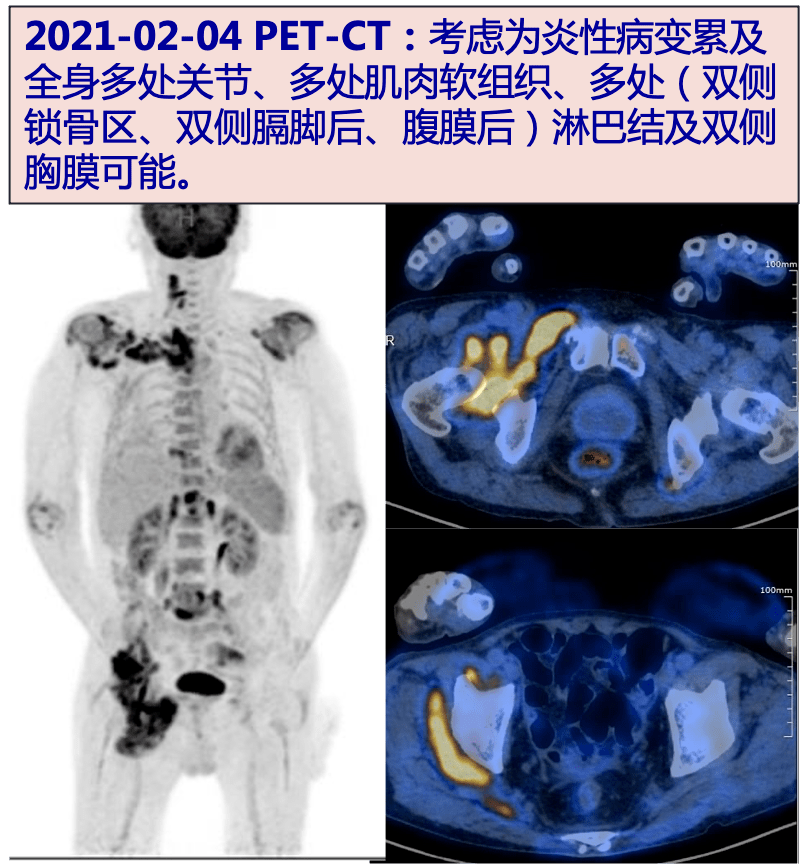 多处肌肉软组织,多处(双侧锁骨区,双侧膈脚后,腹膜后)淋巴结及双侧