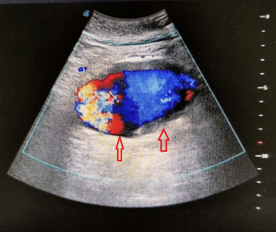 超声医生检查时多看一眼,发现凶险的腹主动脉瘤