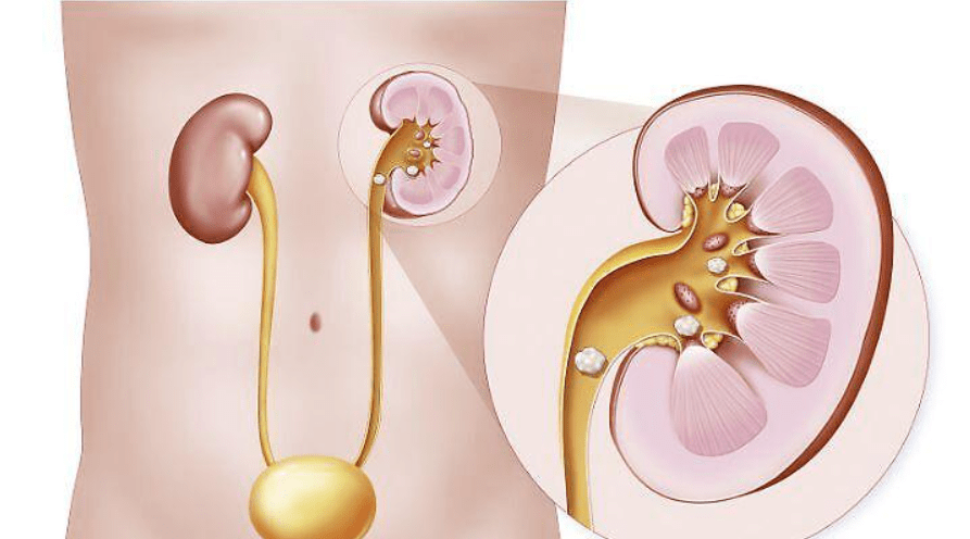 肾结石是怎样引起的啊 a79d436256bf40b792d1cc3e0669ab7e.png