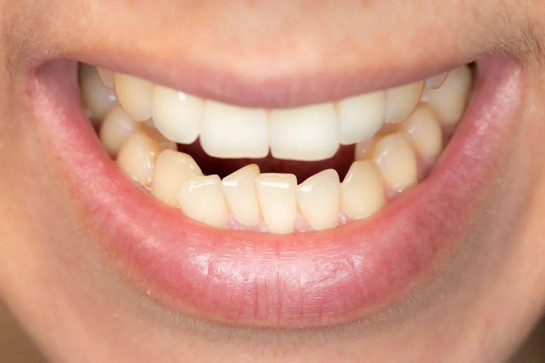 人的牙齿为什么越来越不齐?