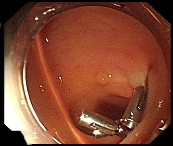 肠镜检查中显示何女士直肠一异物嵌顿,用圈套器将异物取出,直肠壁可见
