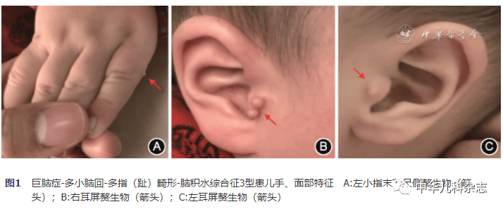 【病例报告】ccnd2基因新发变异致mpph3综合征一例_患儿