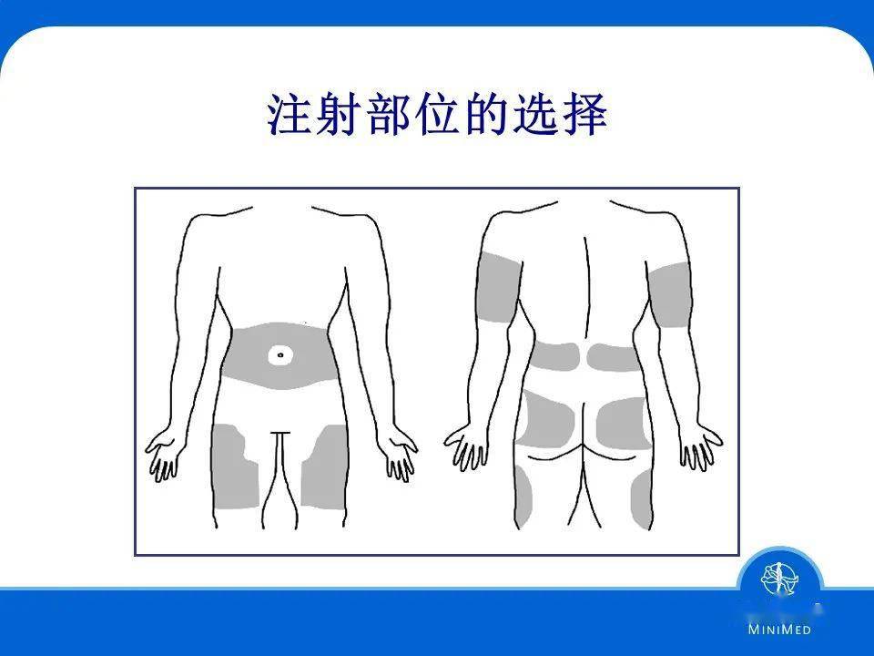 ppt胰岛素泵的使用下