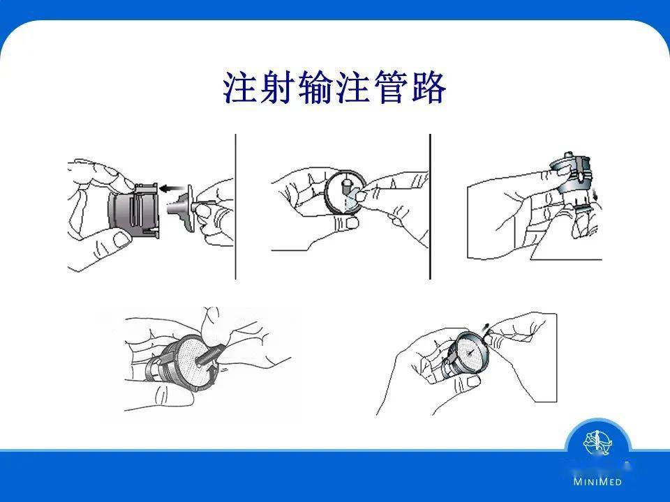 胰岛素泵原理图图片