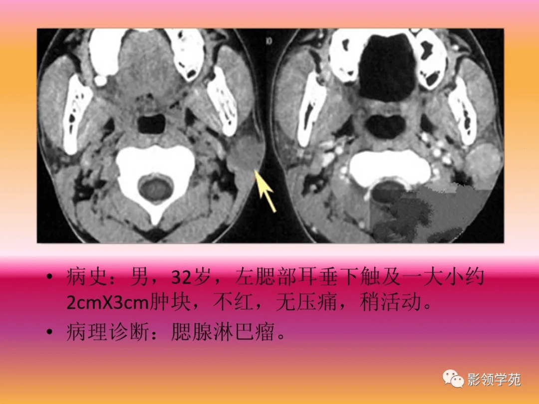 腮腺疾病的CT诊断与鉴别诊断_肿瘤