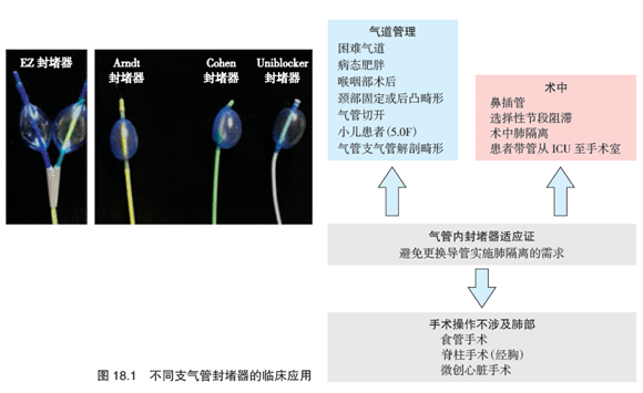 在现代胸科麻醉中,有四种不同的支气管内封堵器应用于临床.