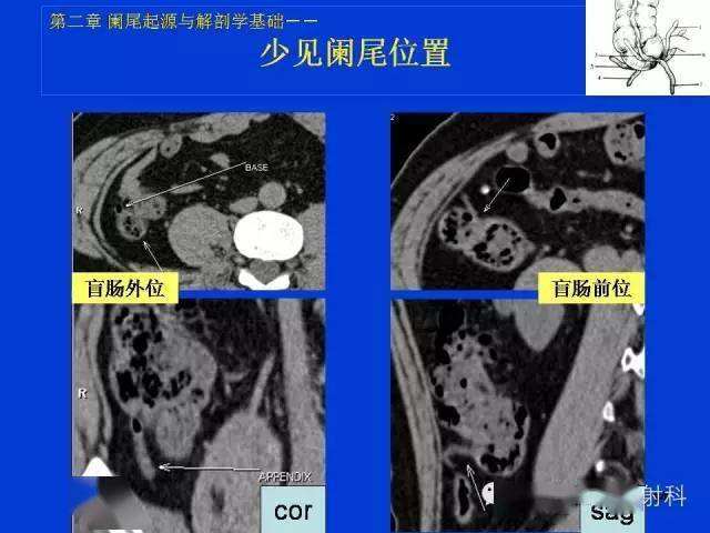 阑尾炎ct怎么看图解图片