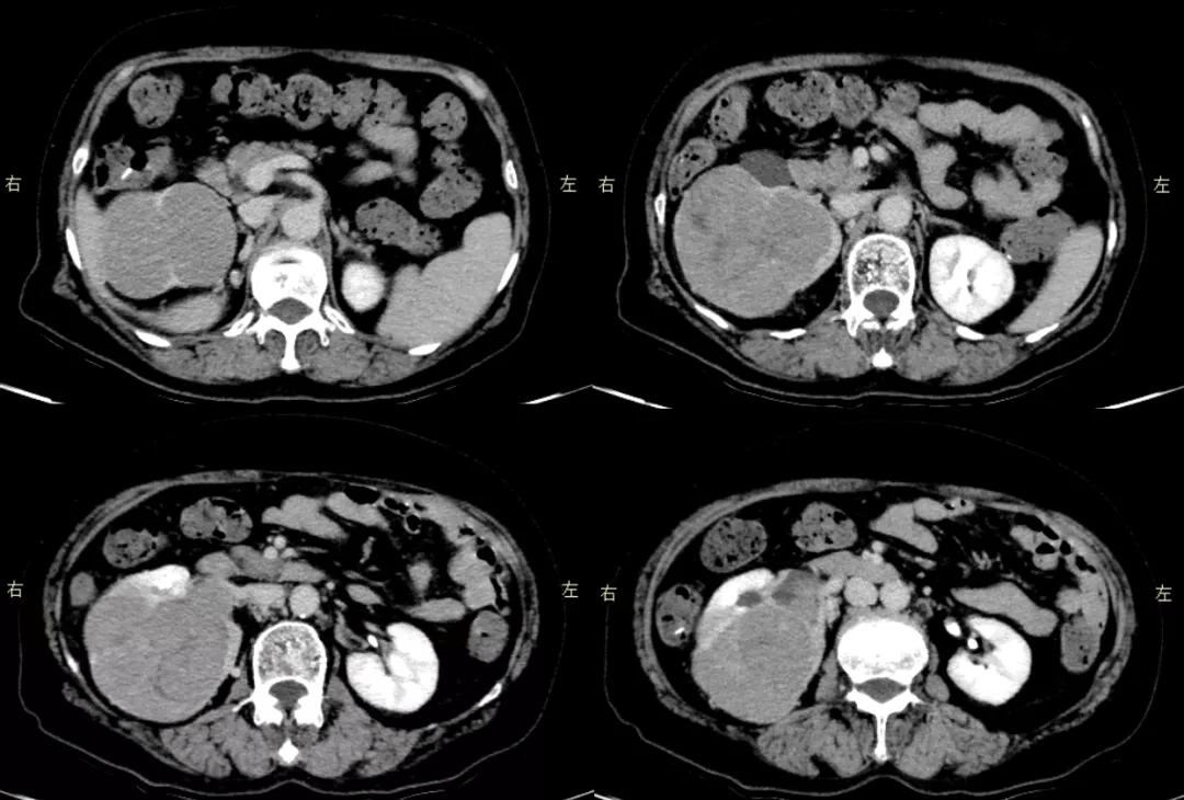 病例賞析 | 腰痛伴血尿,少見且典型的腎腫瘤請你來看