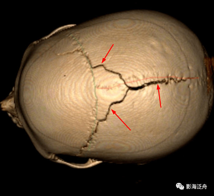 夜班不求人颅骨骨折下