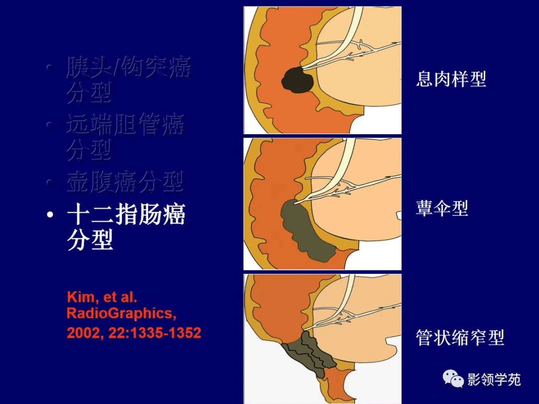 壶腹周围癌图片