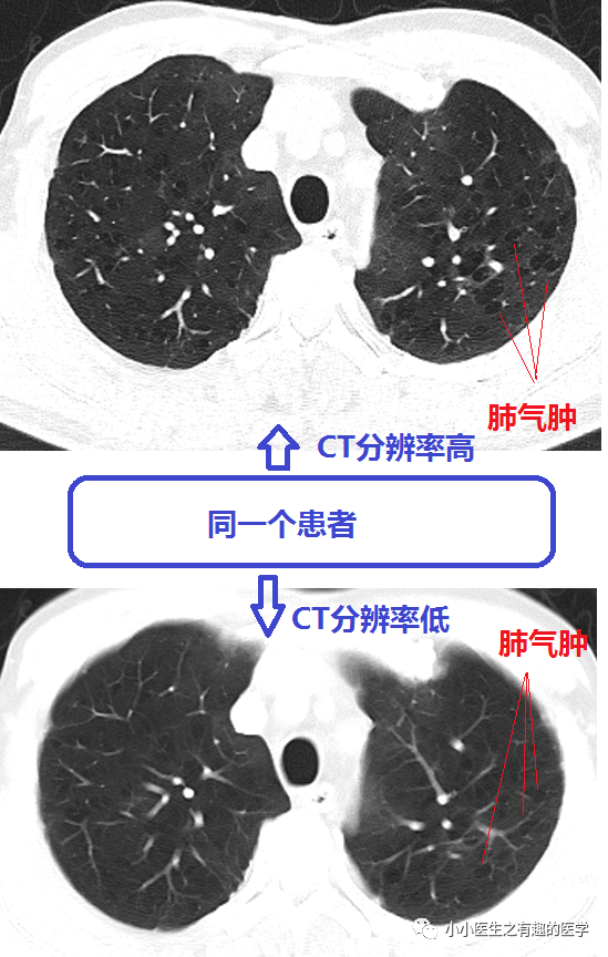 怎样看肺气肿ct图片图片