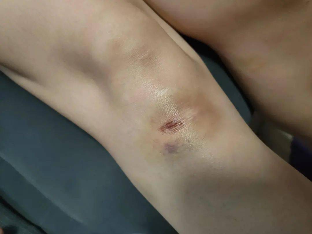 头枕,导致脑袋前后各一个大包,颈椎两节错位,脑震荡,腿和胳膊多处擦伤