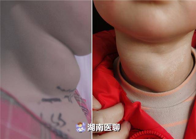 女童患甲状腺癌气管被压成细缝专家高超技术解开封喉肿瘤
