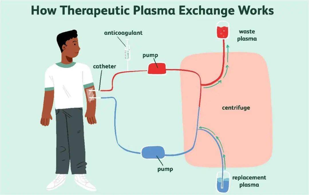 仁济科普清除血液中的雾霾这些神经疾病可以使用血浆置换疗法