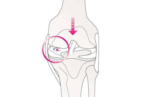 半月板受損難逆轉膝蓋太脆弱這4件事不要做
