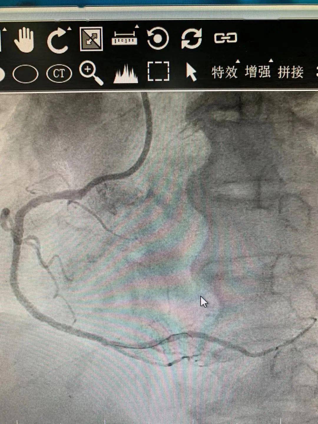冠状动脉血管内超声,介入医生的"第三只眼"