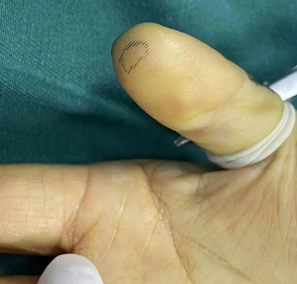 伤口|杭州女子手上长瘤，一张手机膜让她吃尽苦头！网友吓懵：马上换