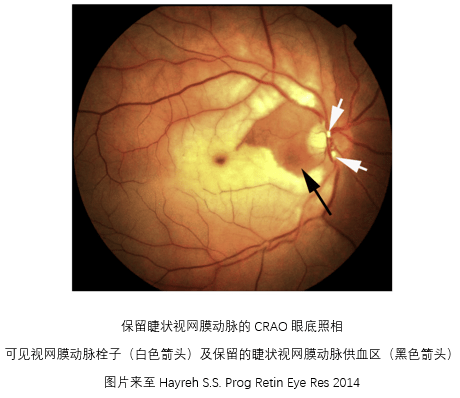 视网膜中央动脉阻塞图片