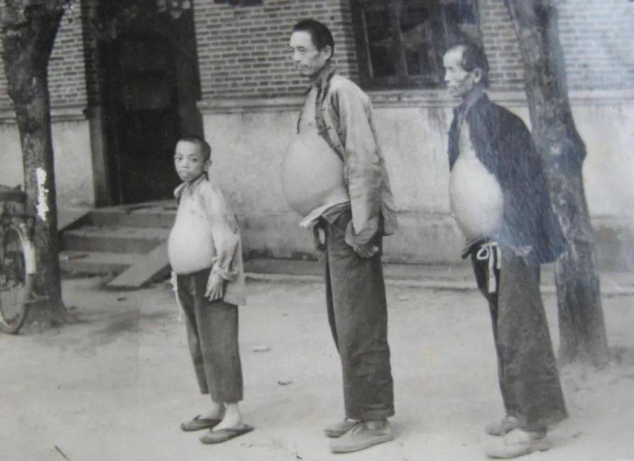 晚期血吸虫病病人血吸虫尾蚴性皮炎在血吸虫感染过程中,尾蚴,童虫