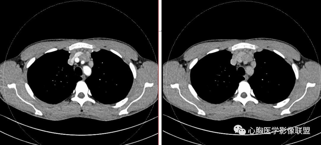 前纵膈病变_纵隔