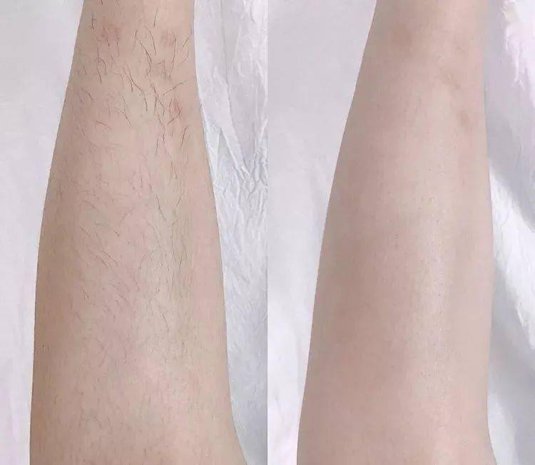 脱毛后能不能用身体乳(脱毛后能不能用身体乳擦脸) 脱毛后能不能用身体乳(脱毛后能不能用身体乳擦脸)