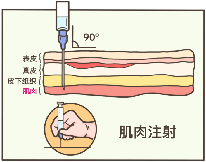 垂直于皮肤 90° 进针