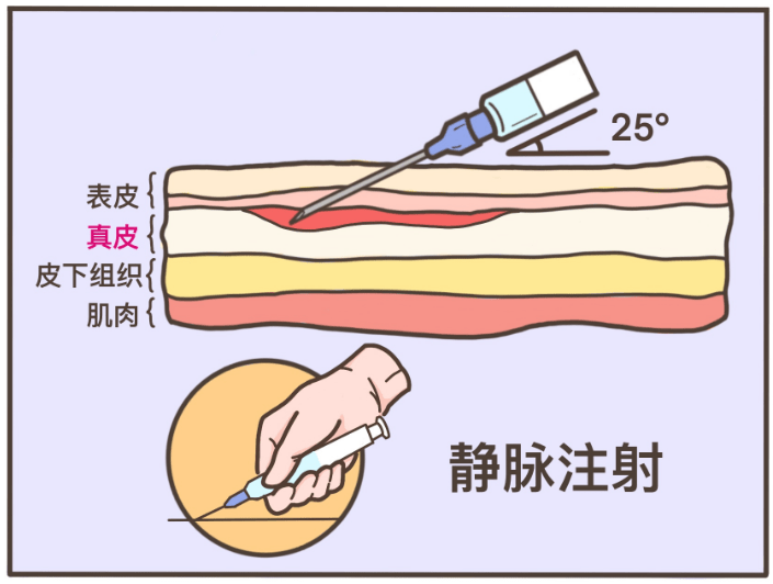 此针式要求护士不偏不倚,不多不少的,将针头以 25° 夹角插入血管内