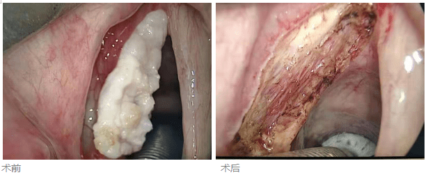 让肿瘤5年的局部控制达94%对于早期声门型喉癌,从肿瘤学疗效上看,浙大