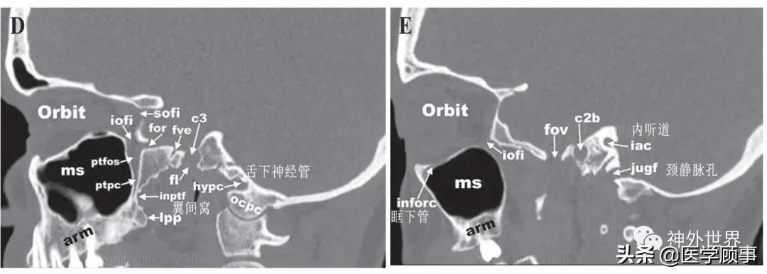 圖4:顱底ct骨性冠狀面影像解剖圖3:顱底ct骨性橫斷面影像解剖1.