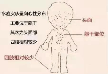 患了水痘的人 通常会出现发烧,发痒的红疹 最初这些红疹先是扁平 其后