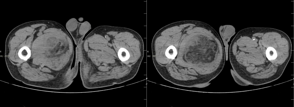 腹膜脂肪瘤图片