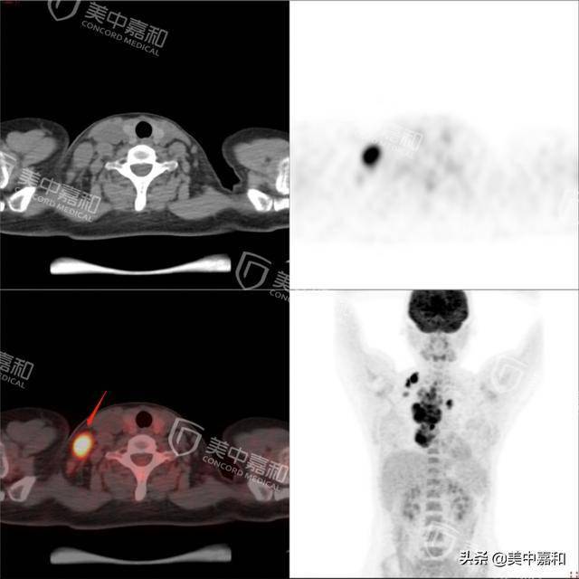 pet/ct影像资料:这次她参加公司的常规体检,医生发现她右颈部一枚肿大