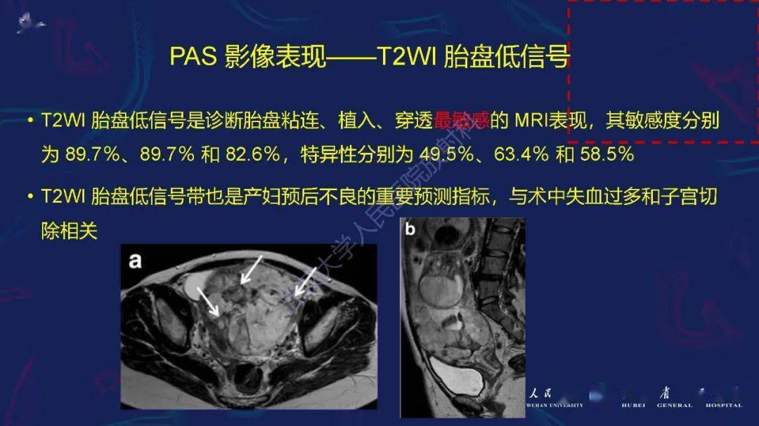 什么叫植入性胎盘 8db71070d4b44366b54b81e39b03a67f.jpeg