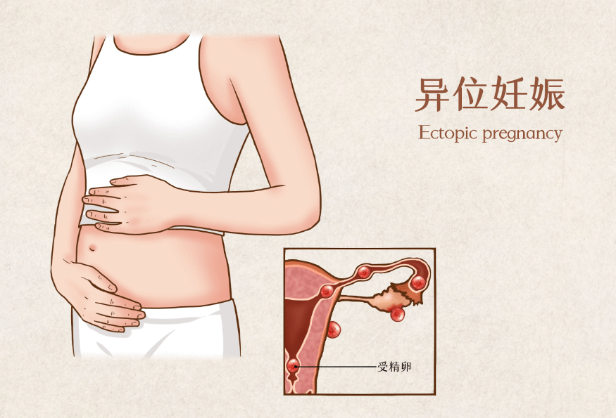 什么情况会导致输卵管有问题 460496be90ce493aa09ee7e1f969ebe1.png