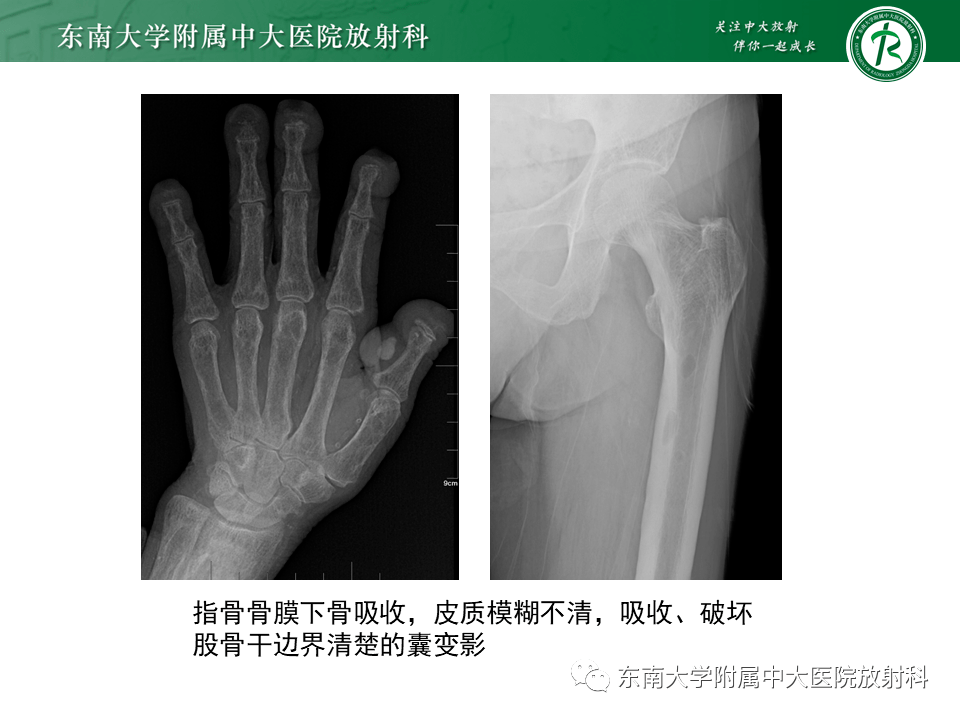 晨读结果公布20210422肌骨系统疾病肾性骨病透析相关淀粉样变dra