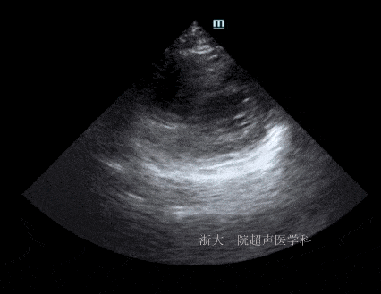 入院48h超声:左室壁未见节段性运动异常.超声提示图3:ef:51%.