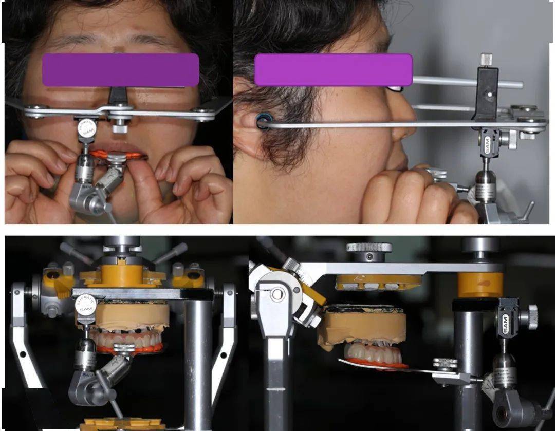 图22 利用第二幅过渡义齿进行面弓转移,并将模型上颌架图23 确定前伸