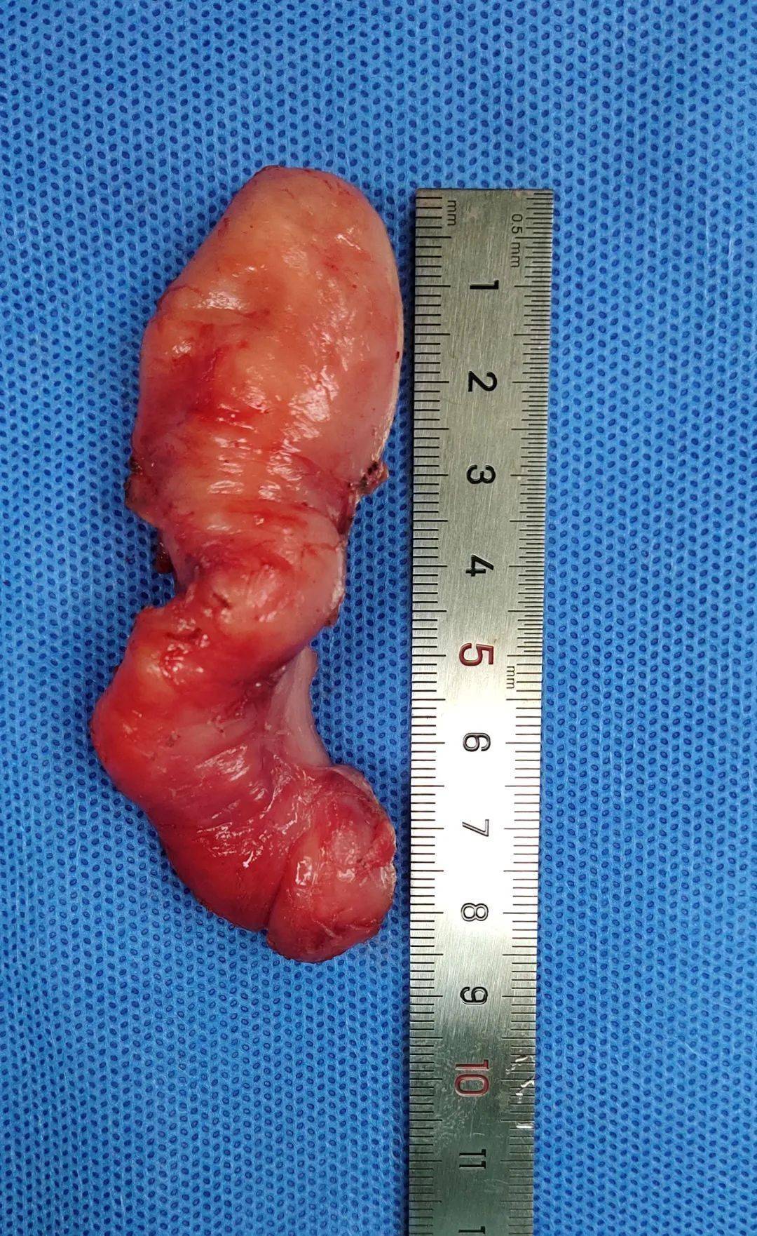 惊呆了食管里面竟然长茄子难怪吃饭难以下咽