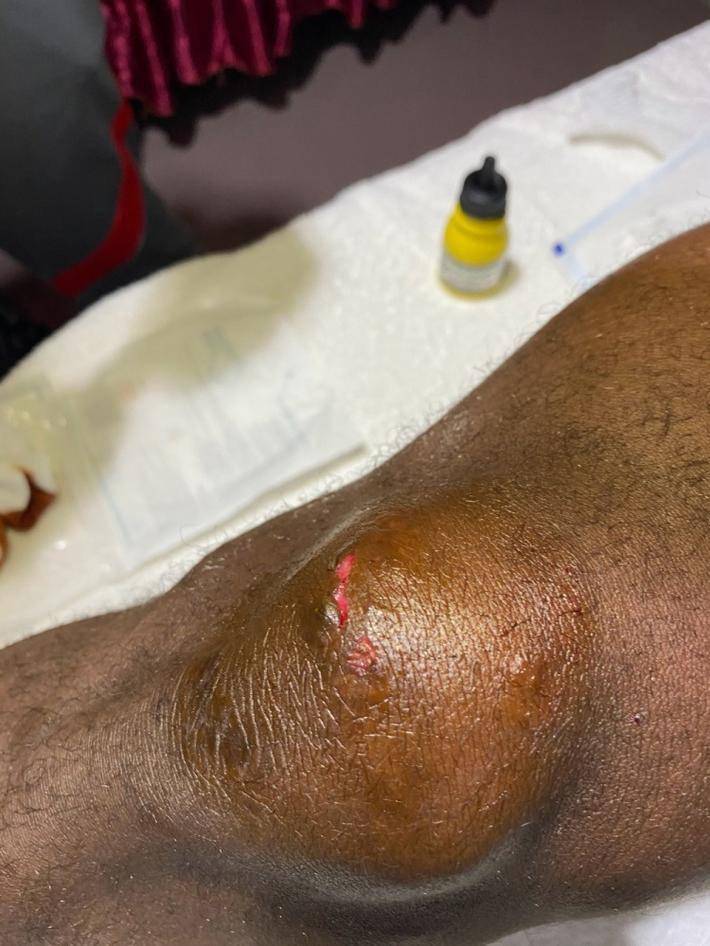 申花新闻官晒巴索戈肿胀膝盖伤口见肉