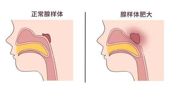 這個名稱大家有可能感到不是很熟悉,這是因為腺樣體本身所存在的位置