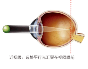 人均近视度数_近视度数对照表(3)